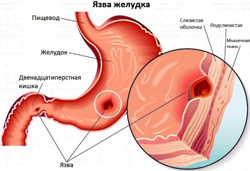 Язва желудка и двенадцатиперстной кишки: симптомы, лечение